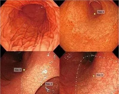 什么是氩气刀什么是萎缩性胃炎？是否癌变？如何治疗？_https://www.jmylbn.com_新闻资讯_第8张