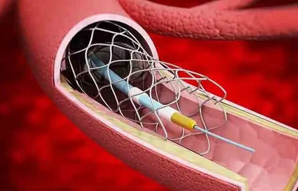 700元冠脉支架来了明年1月10日在河南全面执行