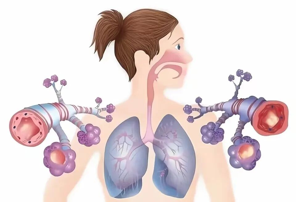 为什么到了夏天慢阻肺更厉害【药学科普】冬病夏治，三伏调理慢阻肺_https://www.jmylbn.com_新闻资讯_第13张