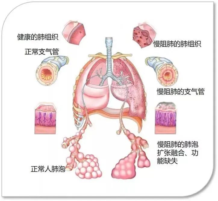 为什么到了夏天慢阻肺更厉害【药学科普】冬病夏治，三伏调理慢阻肺_https://www.jmylbn.com_新闻资讯_第5张