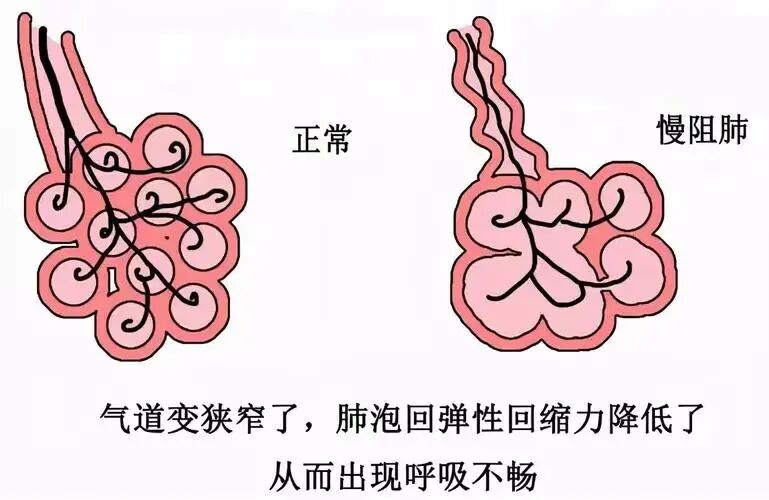 为什么到了夏天慢阻肺更厉害【药学科普】冬病夏治，三伏调理慢阻肺_https://www.jmylbn.com_新闻资讯_第8张