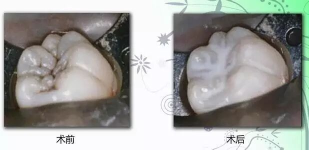 【六一科普】给宝宝做窝沟封闭的4个最佳时机，错过了小心孩子苦