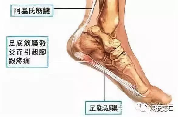 腳底板經常疼，你可能有足底筋膜炎（附康復圖解） 健康 第2張