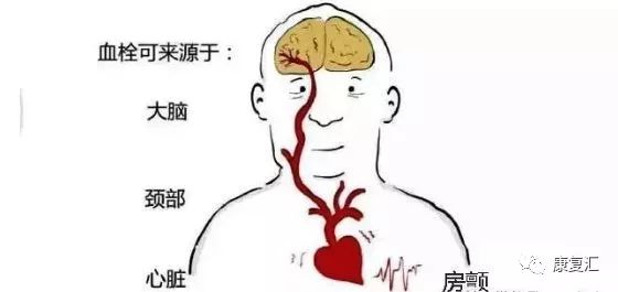 脑卒中康复训练漫画图解-微信头条网 脑卒中康复训练漫画图解