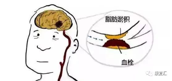 脑卒中康复训练漫画图解-微信头条网 脑卒中康复训练漫画图解