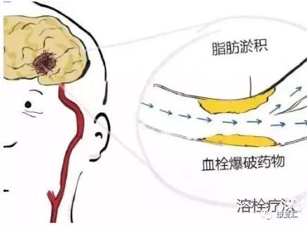 脑卒中康复训练漫画图解-微信头条网 脑卒中康复训练漫画图解