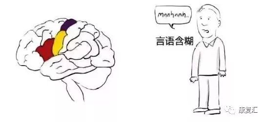 脑卒中康复训练漫画图解-微信头条网 脑卒中康复训练漫画图解