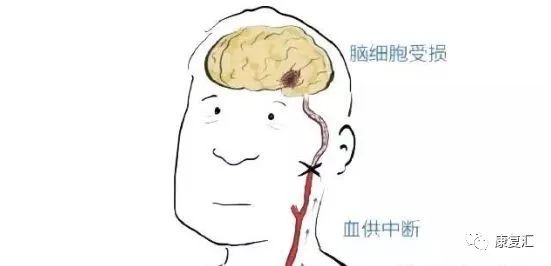 脑卒中康复训练漫画图解-微信头条网 脑卒中康复训练漫画图解