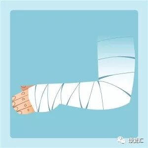 骨折术后的康复期至关重要