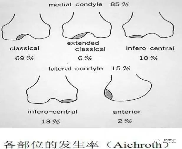 膝關節疼痛的常見病因與康復治療多圖詳解！ 健康 第4張