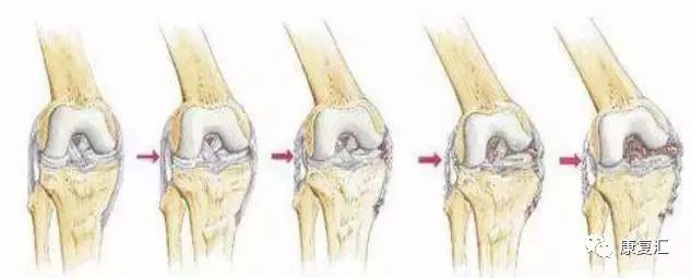 膝關節疼痛的常見病因與康復治療多圖詳解！ 健康 第6張