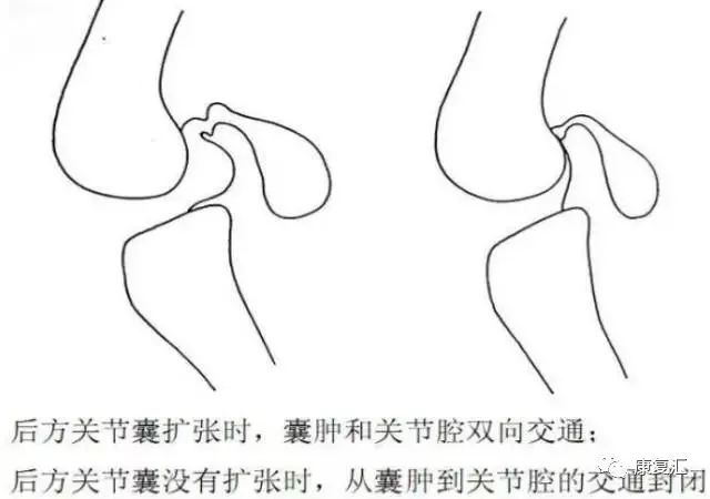 膝關節疼痛的常見病因與康復治療多圖詳解！ 健康 第8張