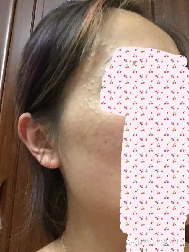结节可考虑玻尿酸溶酶每个结节处微量注射,一般来说溶酶注射在结节