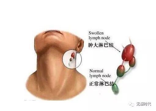 中医治疗甲亢有奇方