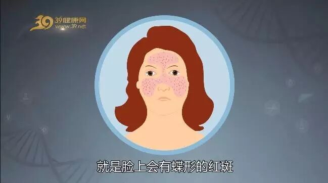 女人越年轻貌美越易得这病脸上长一种斑别以为是皮肤病
