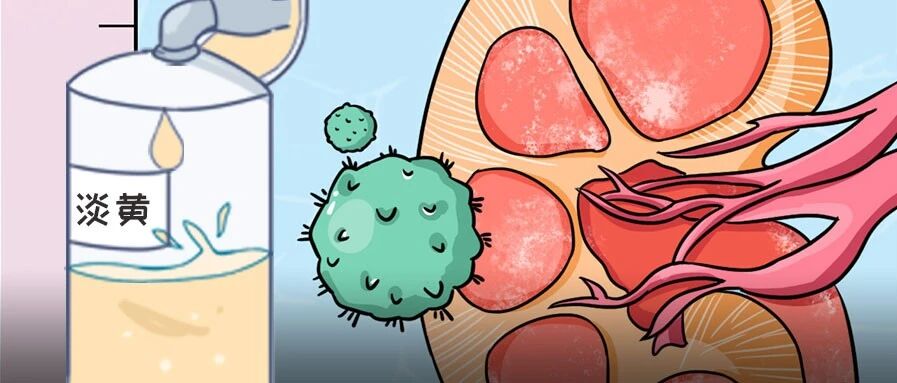 尿液颜色越浅越好？当心这些癌症信号