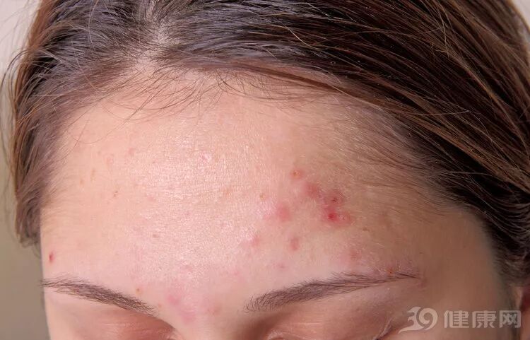 毛囊炎和痘痘，傻傻分不清楚？越拖越严重！