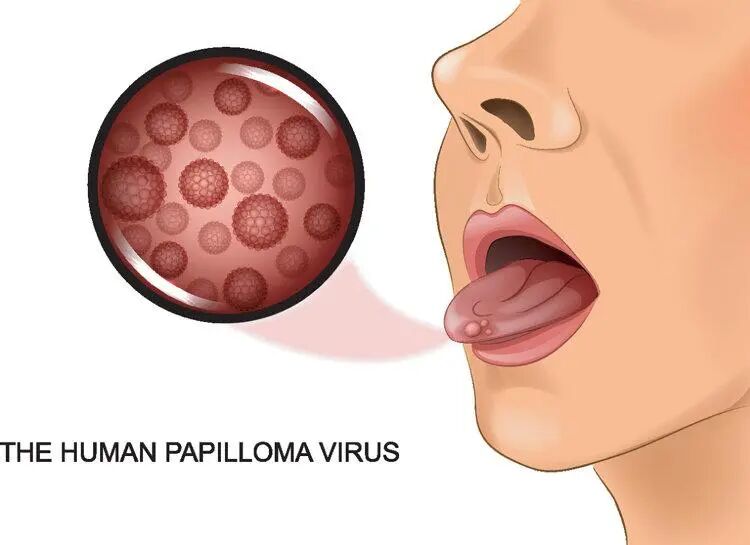 患者自述：边缘性行为，让我患上喉癌！希望你能引以为戒