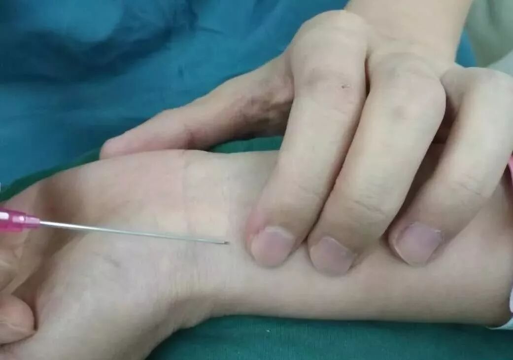 动脉长鞘怎么置入【临床知识】桡动脉穿刺技巧细节要知道_https://www.jmylbn.com_新闻资讯_第7张