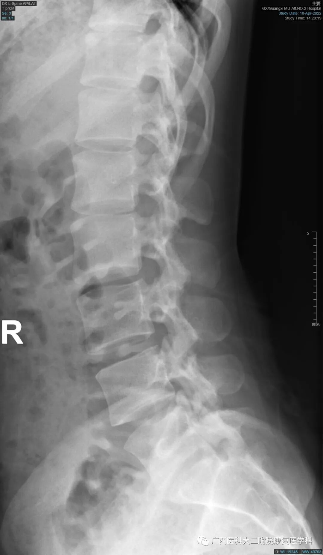 悬吊训练系统 怎么装S-E-T悬吊训练技术在下背痛中的应用_https://www.jmylbn.com_新闻资讯_第6张