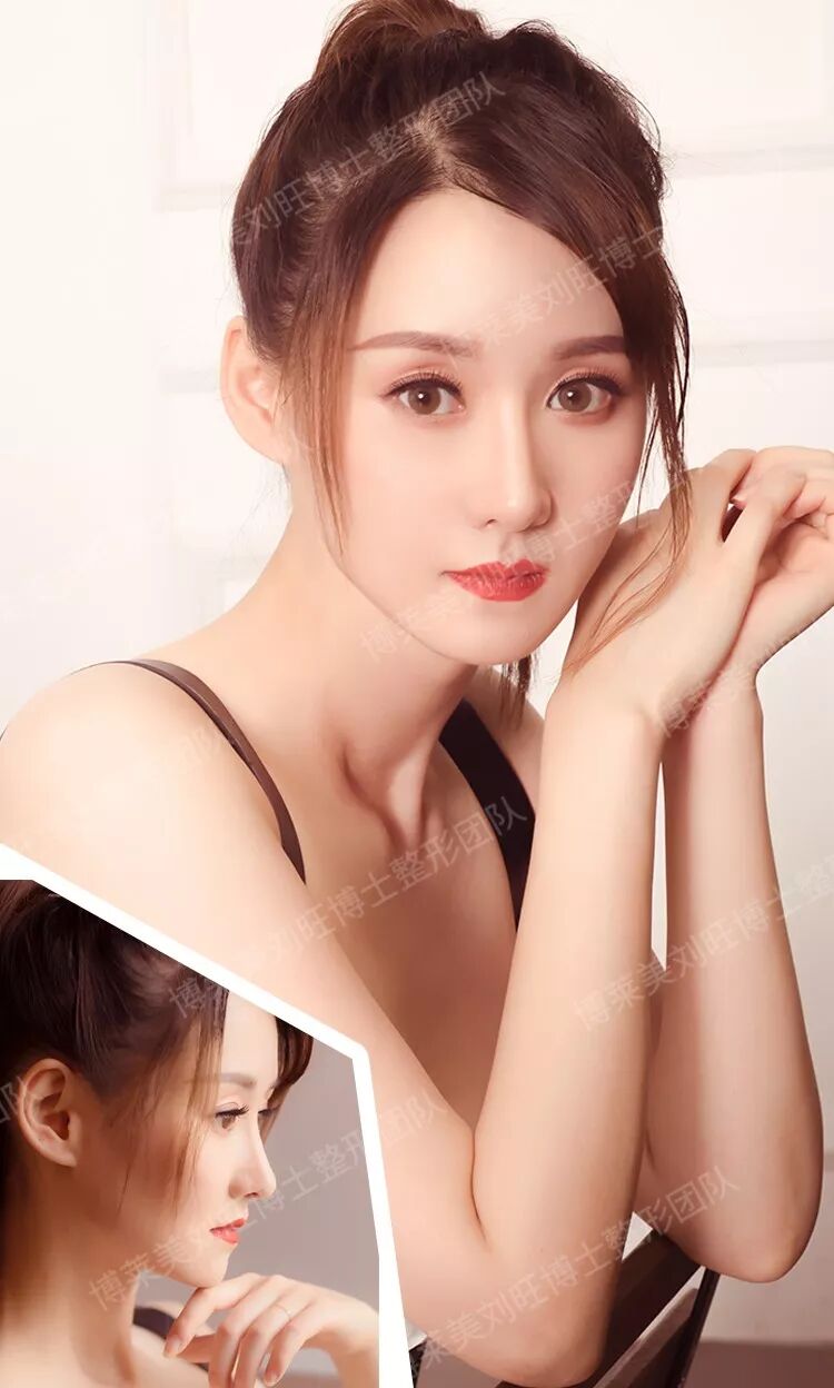 隆鼻取材肋软骨颜值逆风大翻盘丨真人案例 刘旺整形博士 微信公众号文章阅读 Wemp