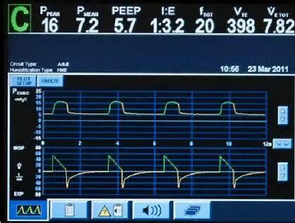 怎么备呼吸机ICU必备工具：呼吸机的使用你知多少_https://www.jmylbn.com_新闻资讯_第3张