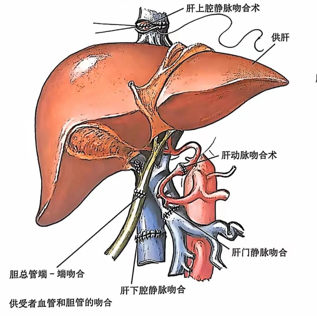 手术解剖专场|肝移植，从绝望中寻找85%的希望？这背后的手术操作，你懂多少？
