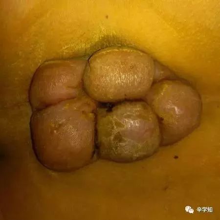 征兵季，莫因痔疮被拒门外