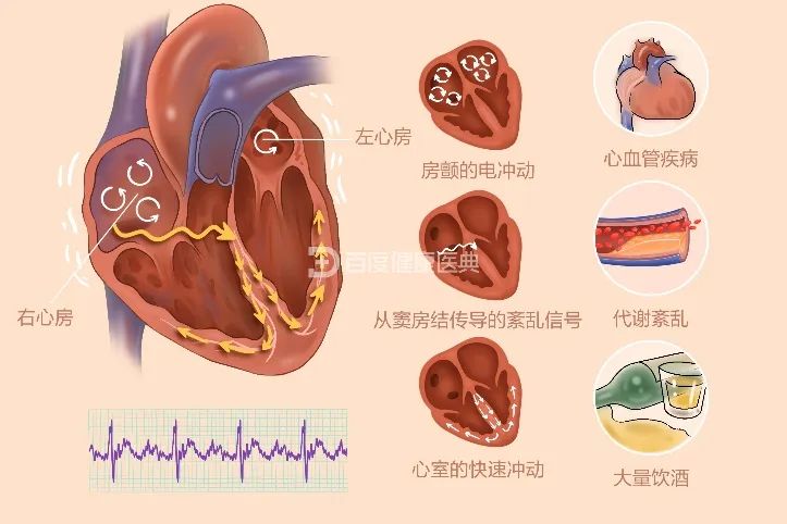 左心耳位置图片