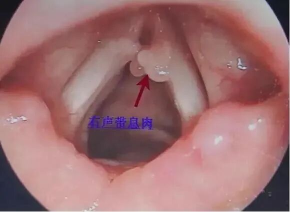 喉镜是什么科【九院精术】耳鼻喉科引进电子喉镜，让您告别咽喉检查之苦_https://www.jmylbn.com_新闻资讯_第6张