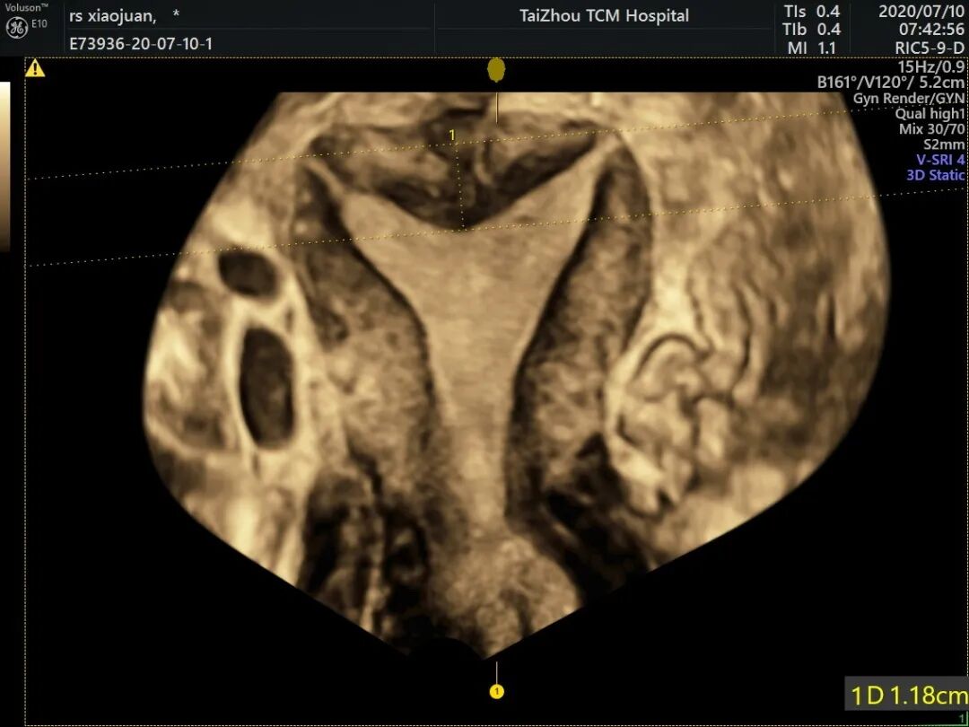 为什么妇科检查灯那么暗【秋来“孕”转】女性健康探路灯——泰州市中医院能做哪些妇科超声检查？_https://www.jmylbn.com_新闻资讯_第8张