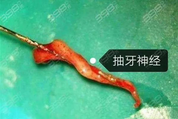 牙神经长什么样子？通过取出来的牙神经图片了解