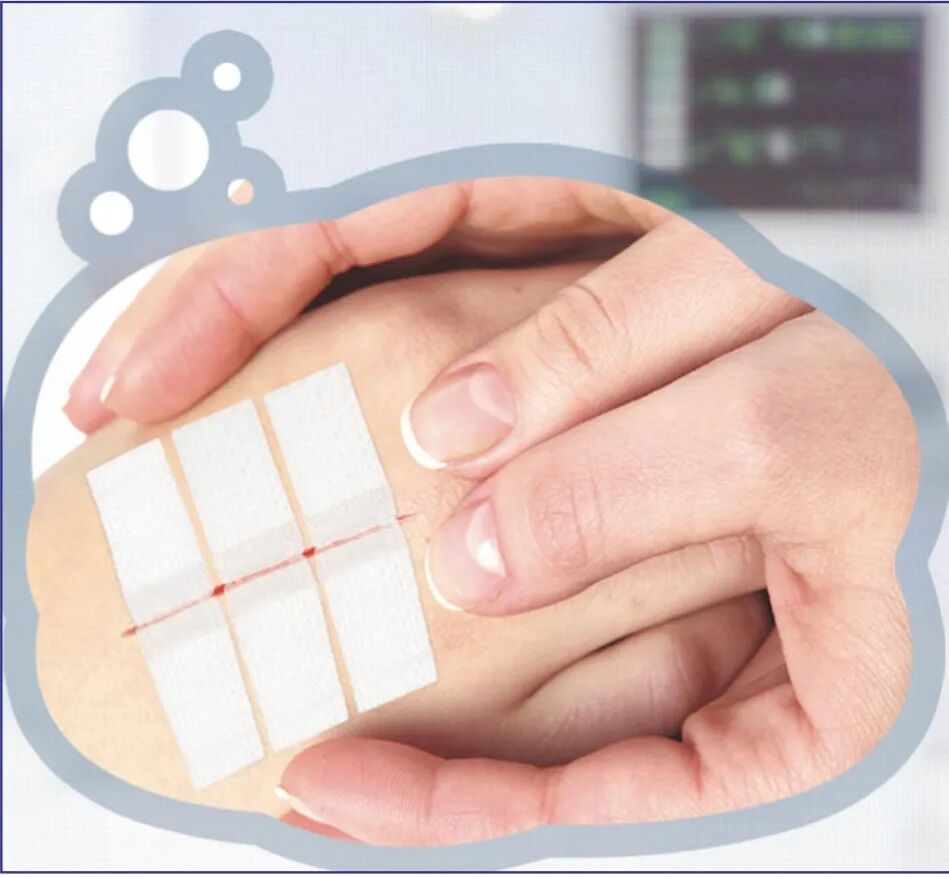 为什么要用皮肤缝合器【产品介绍】一次性使用皮肤缝合器_https://www.jmylbn.com_新闻资讯_第5张