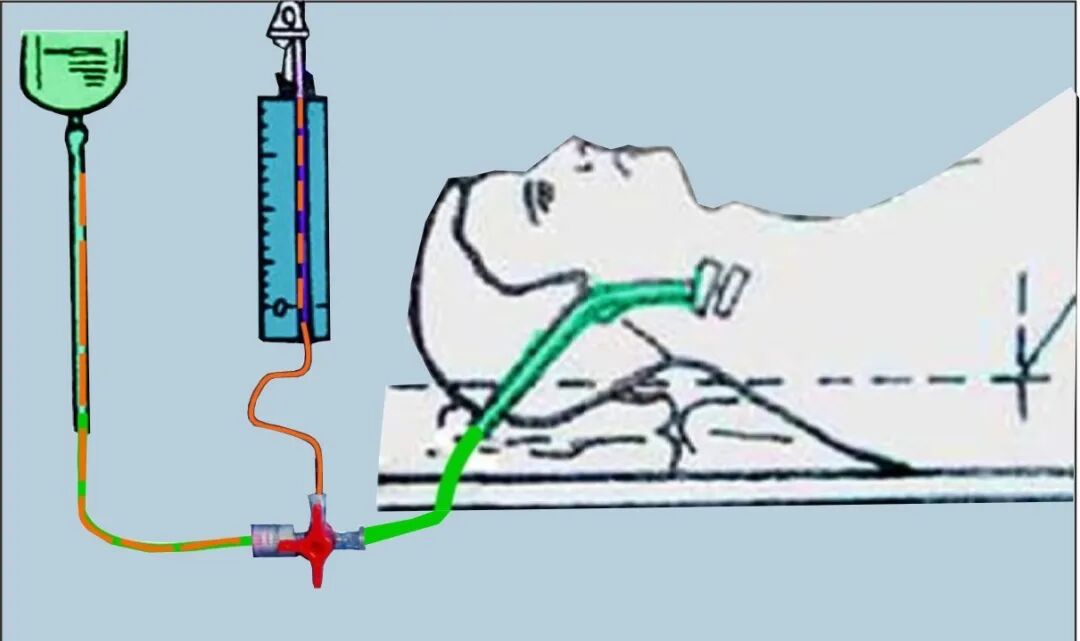 【临床知识】中心静脉压知识普及