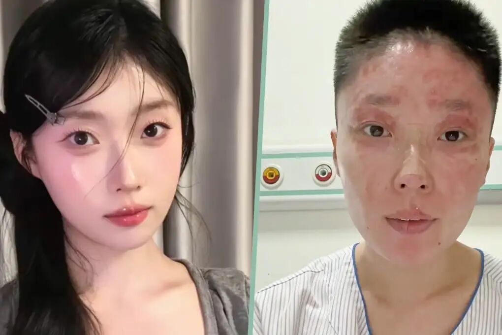 A model and make-up artist survived a gas explosion at her home in which she suffered 14 per cent burns and her parents were severely injured. Photo: SCMP composite/Douyin