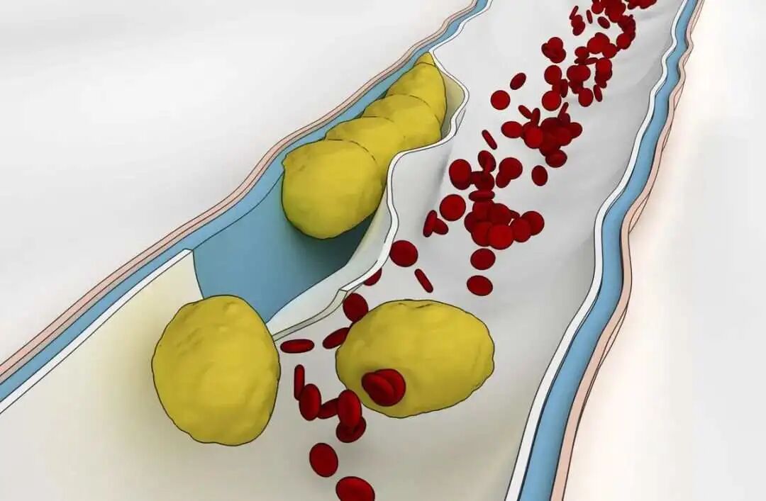 常用的他汀类药物，哪个最好？