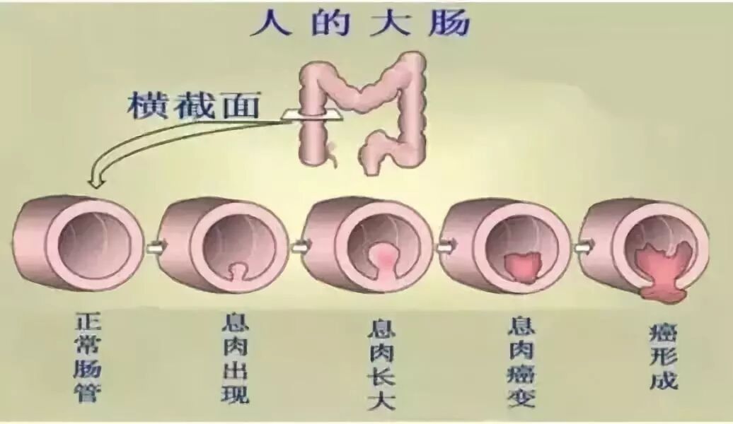 说好的结肠息肉怎么说癌变就癌变了