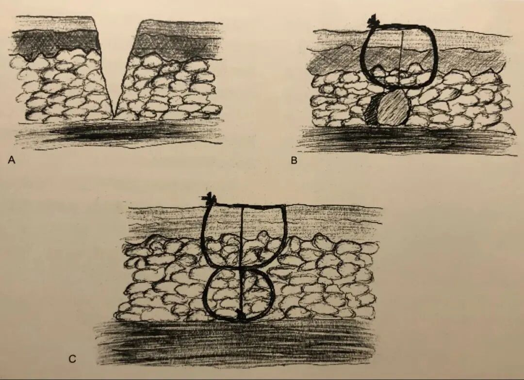 为什么要结扎血管谈骨论筋丨最全的外科手术基本功，别怪我没告诉你！_https://www.jmylbn.com_新闻资讯_第28张