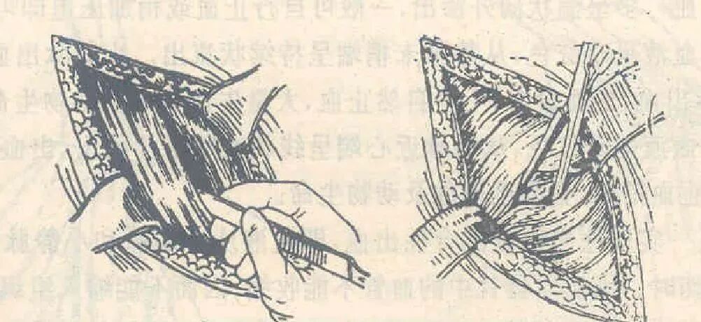 为什么要结扎血管谈骨论筋丨最全的外科手术基本功，别怪我没告诉你！_https://www.jmylbn.com_新闻资讯_第24张