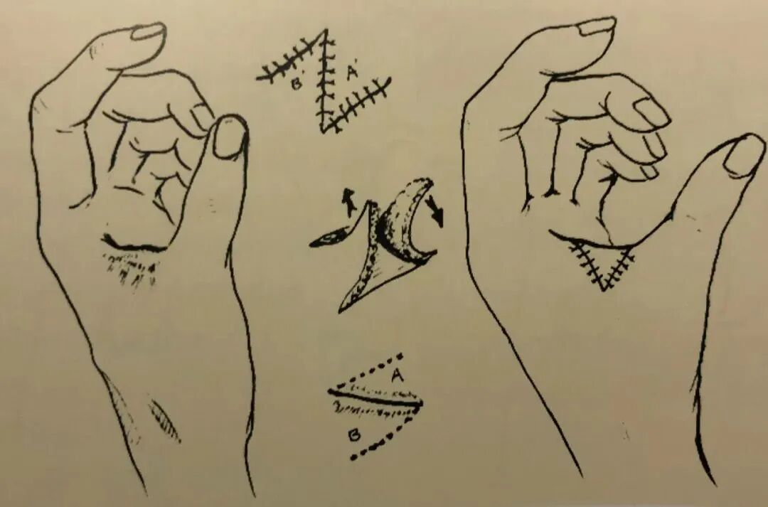 为什么要结扎血管谈骨论筋丨最全的外科手术基本功，别怪我没告诉你！_https://www.jmylbn.com_新闻资讯_第37张