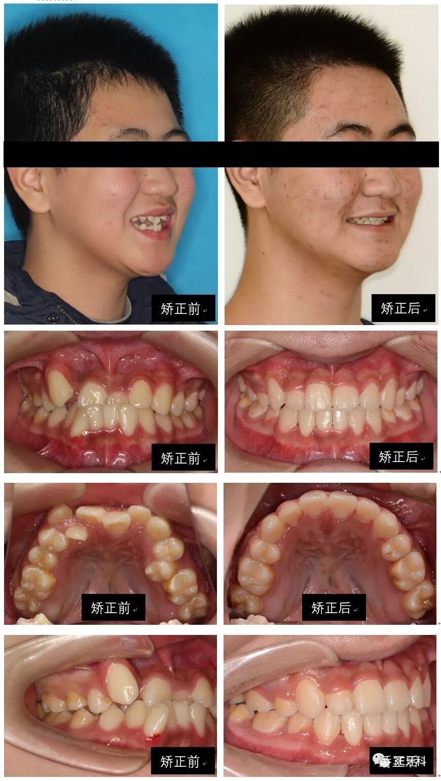 骨性"地包天"隐形矫治病例——入选隐适美国际病例库_牙颌畸形_牙颌