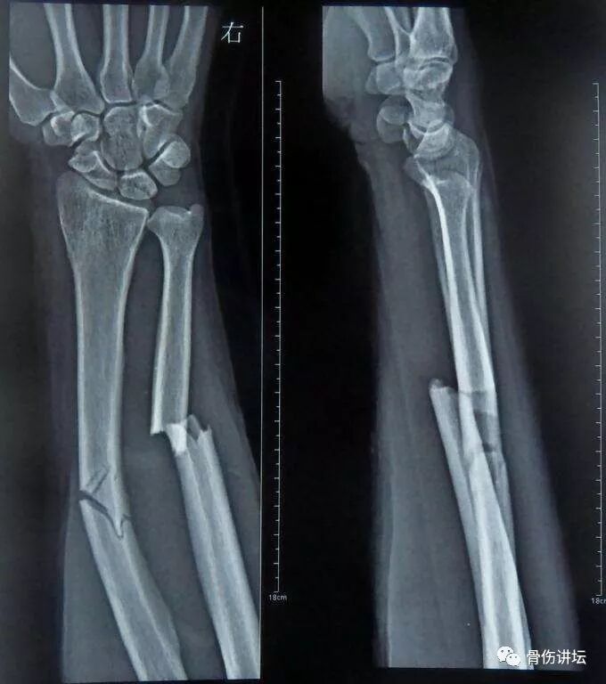 骨头断了咋办 骨折 骨折疾病介绍