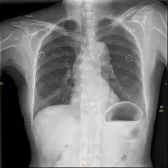 X光拍片为什么要等【影像科普】拍片为什么会要求脱衣服？_https://www.jmylbn.com_新闻资讯_第10张