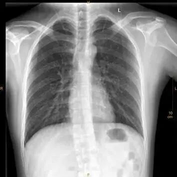 X光拍片为什么要等【影像科普】拍片为什么会要求脱衣服？_https://www.jmylbn.com_新闻资讯_第11张