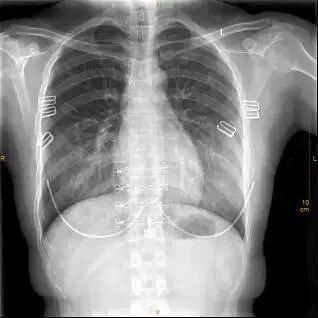 X光拍片为什么要等【影像科普】拍片为什么会要求脱衣服？_https://www.jmylbn.com_新闻资讯_第5张