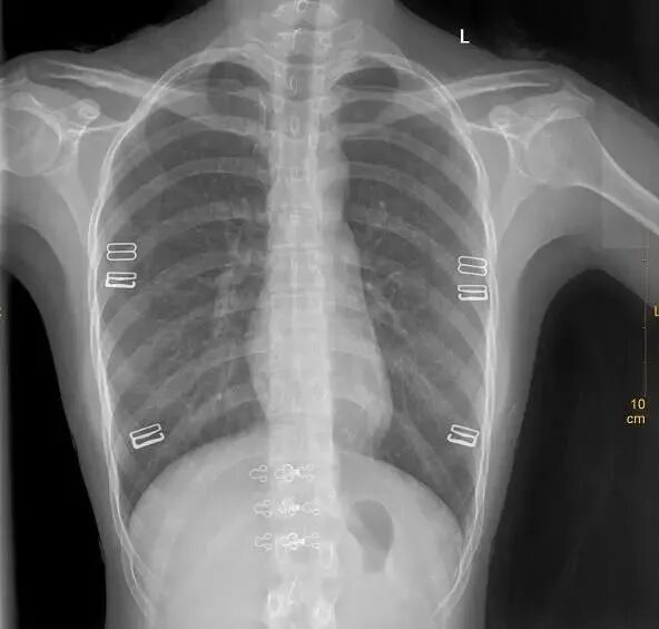 X光拍片为什么要等【影像科普】拍片为什么会要求脱衣服？_https://www.jmylbn.com_新闻资讯_第6张