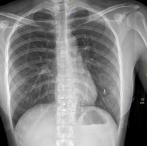 X光拍片为什么要等【影像科普】拍片为什么会要求脱衣服？_https://www.jmylbn.com_新闻资讯_第8张