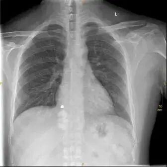 X光拍片为什么要等【影像科普】拍片为什么会要求脱衣服？_https://www.jmylbn.com_新闻资讯_第12张