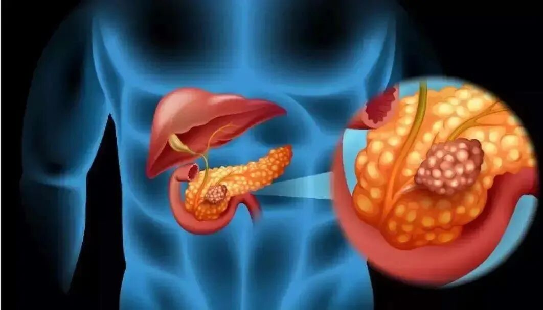 “癌王”胰腺癌，一旦发现就晚期？出现4个症状，一定要注意！