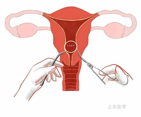 上環取環你必須瞭解的那些事兒